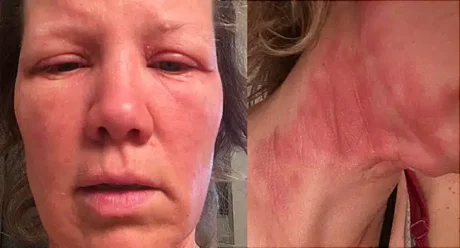 essential oil burns alt.jpg