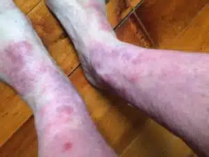 beforeeczema