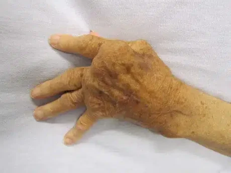 512px Rheumatoid Arthritis James Heilman MD CC BY SA 3.0.jpg