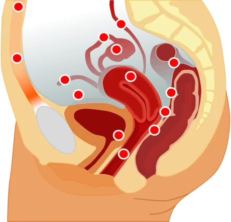 800px Endometriosis loc en.svg .png 1