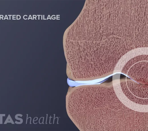 cartilage degeneration knee oa